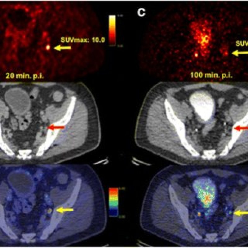 Ga-PSMA-11-PET-CT-imaging-in-the-staging-of-a-patient-with-intermediate-risk-prostate_Q320