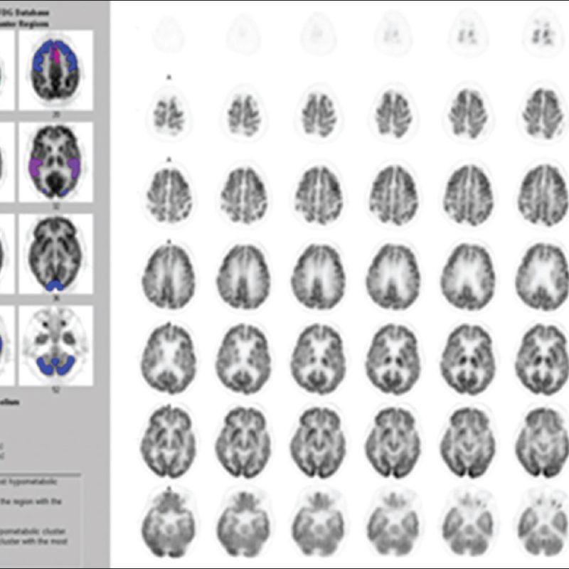 WorldJNuclMed_2017_16_2_108_203075_f1